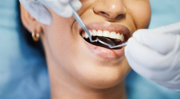 Best Emergency Wisdom Teeth Removal in Seal Beach, CA