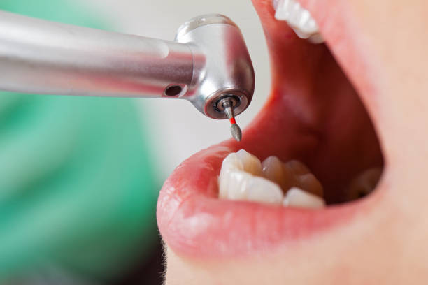 Best Emergency Root Canal Treatment in Seal Beach, CA